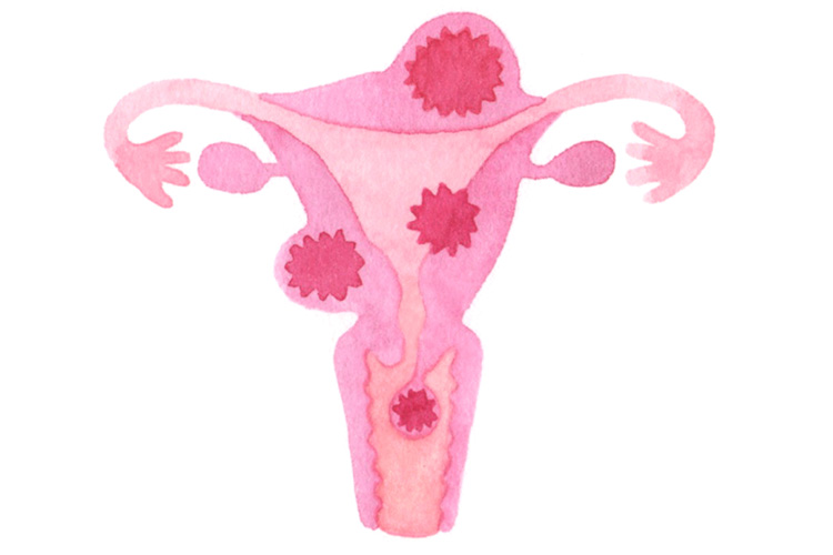 子宮筋腫のイメージ画像
